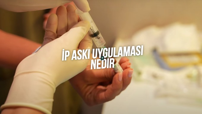 İp Askı Uygulaması nasıl yapılır?