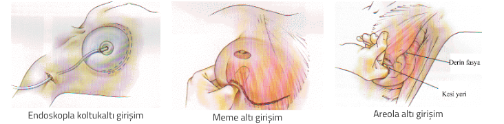 fuat yüksel - meme büyütme